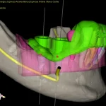 Implants