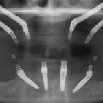 Immediate Restoration with Zygomatic Implants