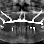 Implants