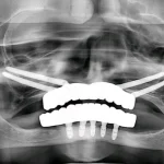Implants