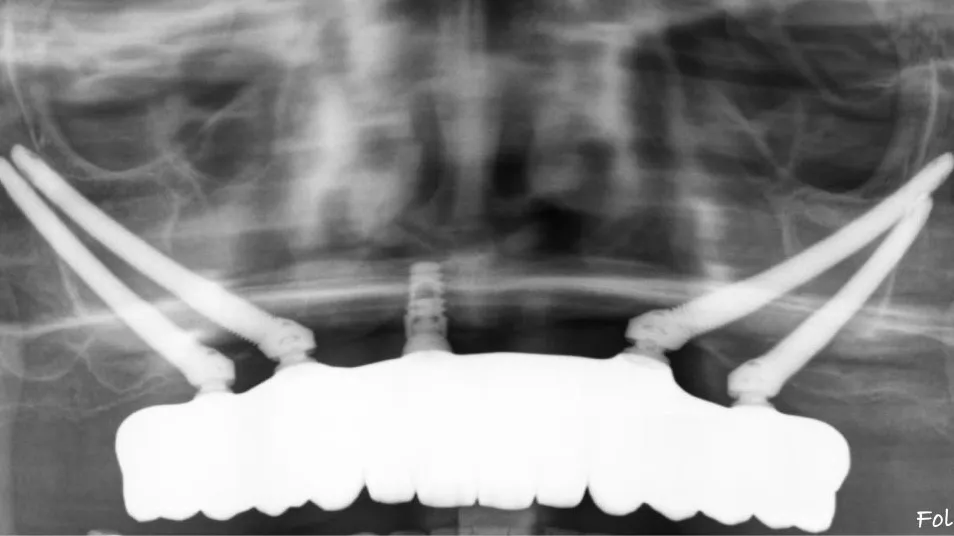 restauracion-03 restauracion-03