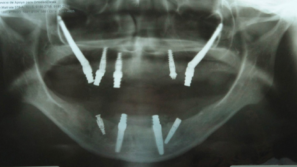 restauracion-1 restauracion-1