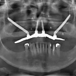 Implants