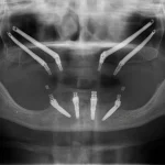 Implants