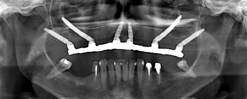 Pterygoid Implants