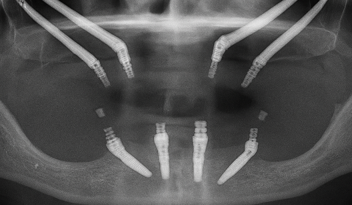 Zygomatic Implants
