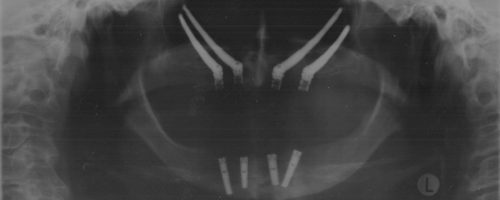 Zygomatic Implants