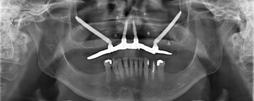 Transnasal Implants